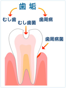 虫歯ってどうしてなるの？