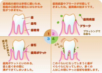 歯周病ってどうしてなるの？