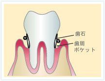 初期の歯周病