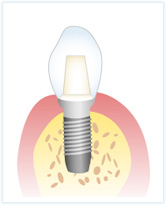 インプラント治療の特長