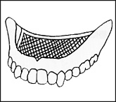金属床の入れ歯（メッシュタイプ）